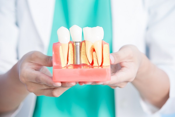 All On  : Can I Replace Multiple Missing Teeth?