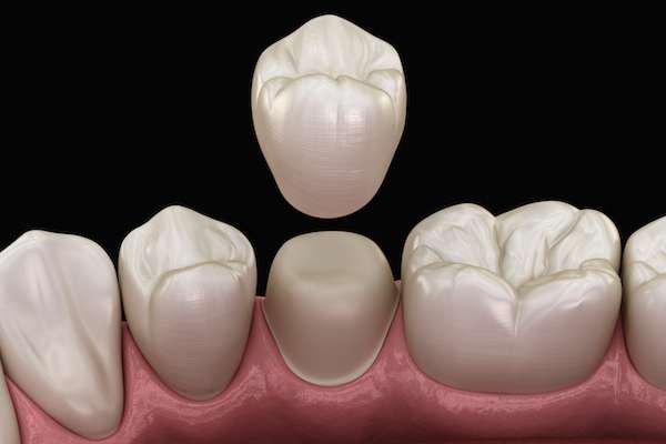 What To Ask Your General Dentist When Preparing For A Crown