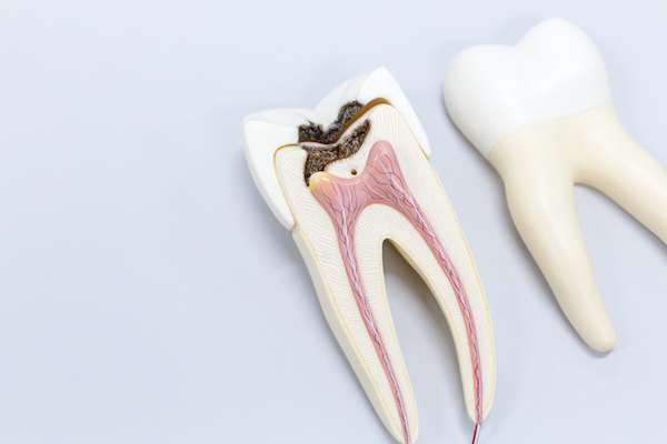 Ask a General Dentist: Is a Tooth Dead After a Root Canal from Dennis Baik, DDS in San Jose, CA