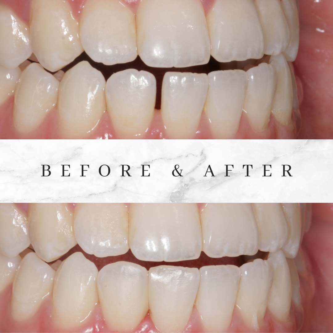 Second Before and After photo of Bioclear