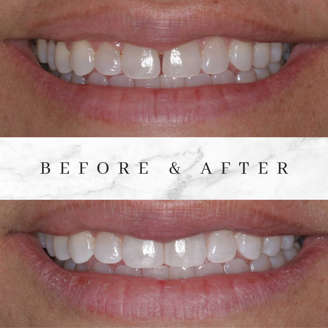 Third Before and After photo of Bioclear