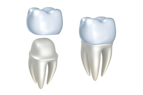 The Anatomy Of Dental Implants