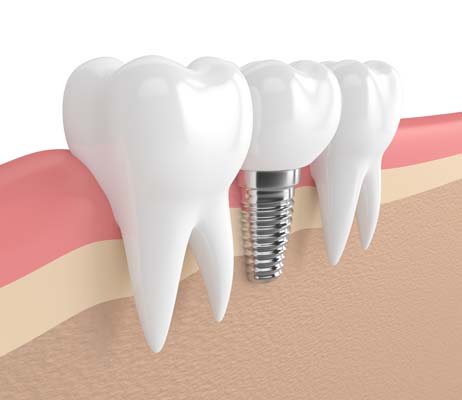 Dental Implants San Jose, CA