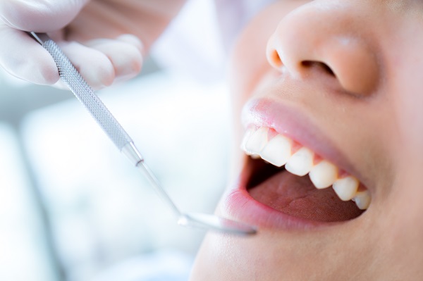 How A Dental Sealant Can Prevent Cavities