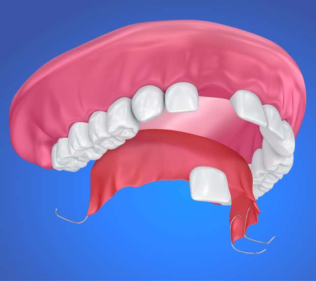 San Jose Partial Denture for One Missing Tooth